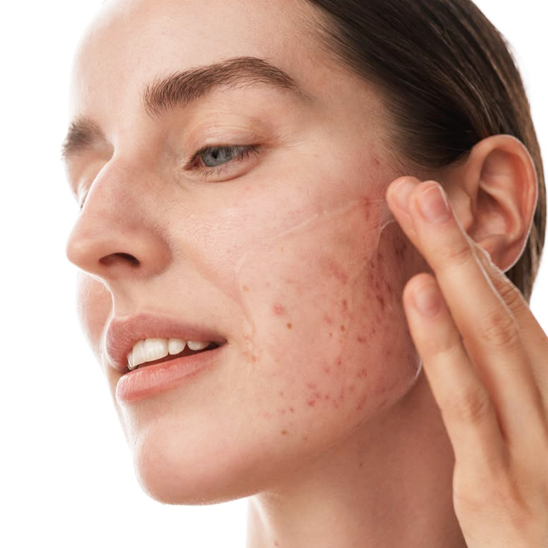 Acne