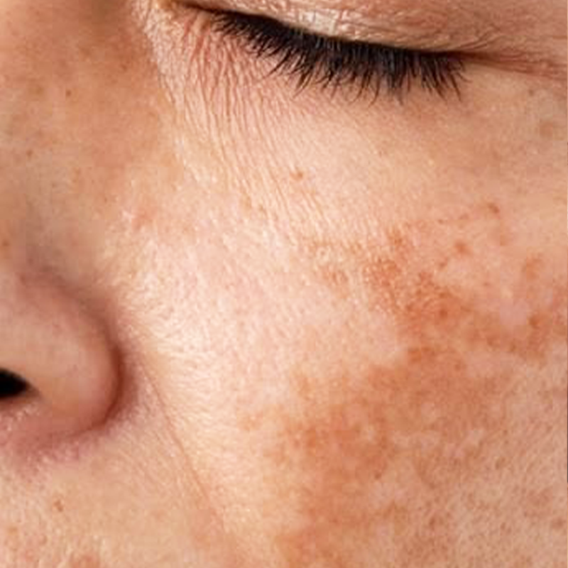 Pigmentation